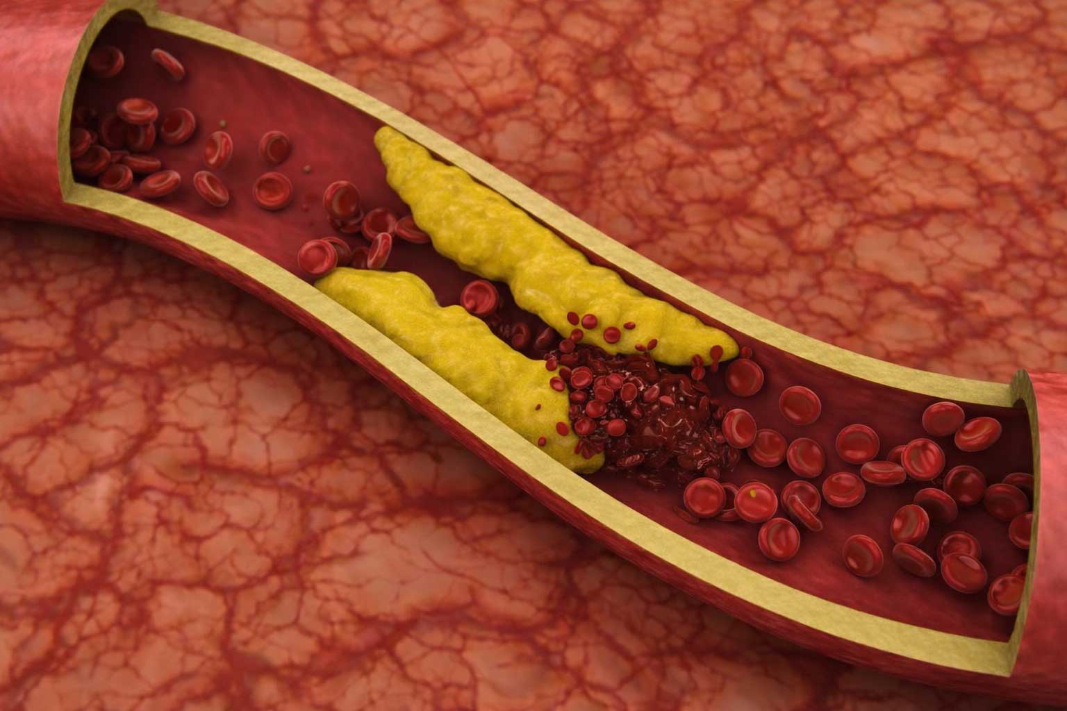 Apolipoproteína B (ApoB): qué es y por qué es el mejor marcador del riesgo cardiovascular aterosclerótico